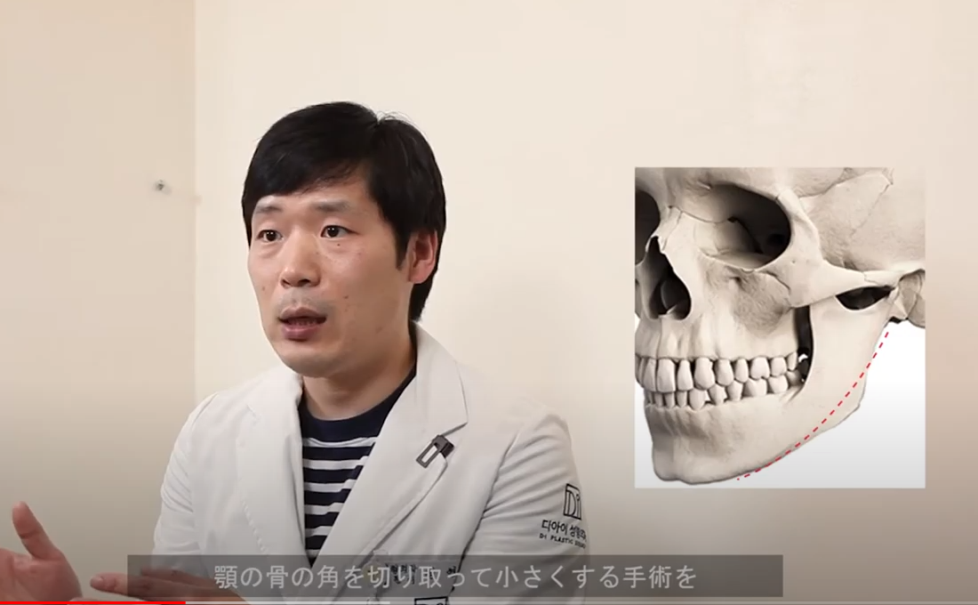 韓国有名整形外科医が徹底解説 最近人気の輪郭手術とは 両顎整形 エラ削りの違いやダウンタイムの長さ