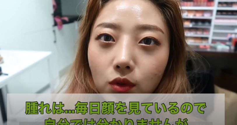 韓国整形 わし鼻整形後2週間のダウンタイム Part2